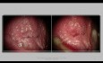 Vulva 22 Years Vin 2 Condyloma Treatment