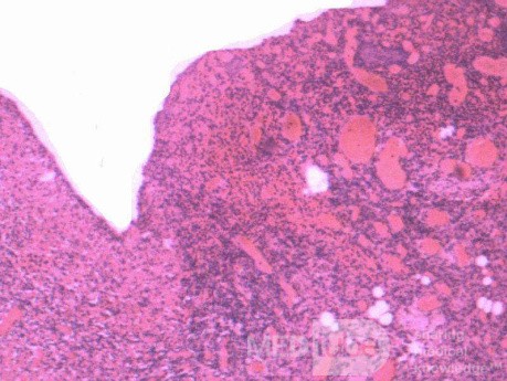 Multiple Rectal Ulcers (108 of 110)