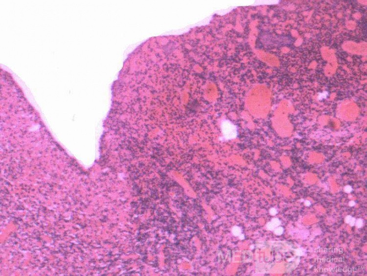Multiple Rectal Ulcers (108 of 110)