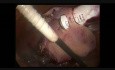 Morcellation for Specimen Removal