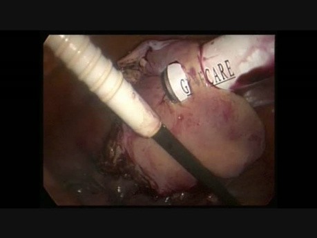 Morcellation for Specimen Removal
