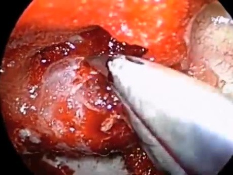 Endoscopic Removal of Pituitary Macroadenoma
