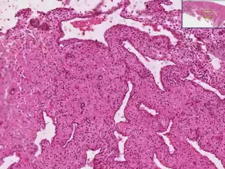 Decidual reaction - Histopathology of uterus