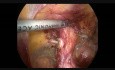 Laparoscopic TAPP Mesh Repair of Inguinal Hernia
