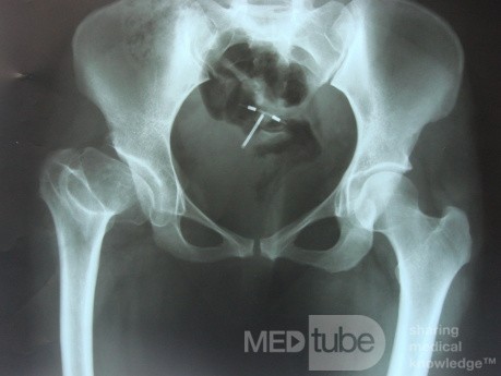 Coxa Plana Rt. Hip