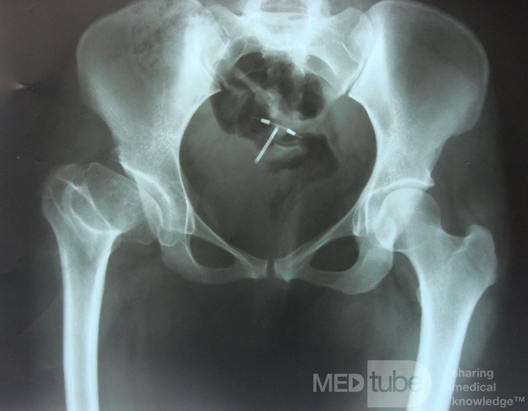 Coxa Plana Rt. Hip