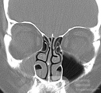 Maxillary Sinus Hypoplasia [Type2]