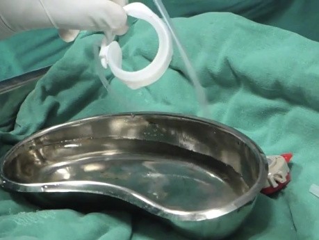 Laparoscopic gastric band
