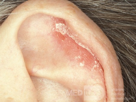 Psoriasis Vulgaris Pinna
