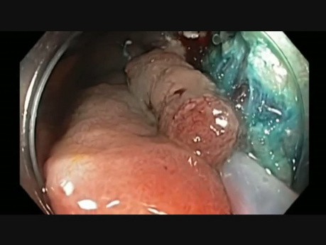 Colonoscopy - Ascending Colon EMR - Large Flat Lesion