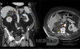 A Big Adrenal Angiomyolipoma