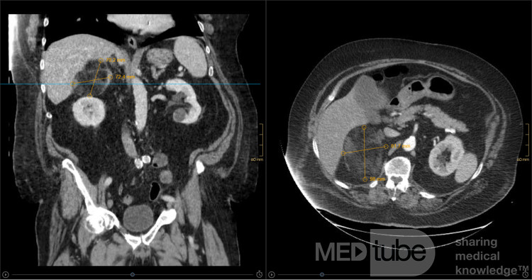 A Big Adrenal Angiomyolipoma