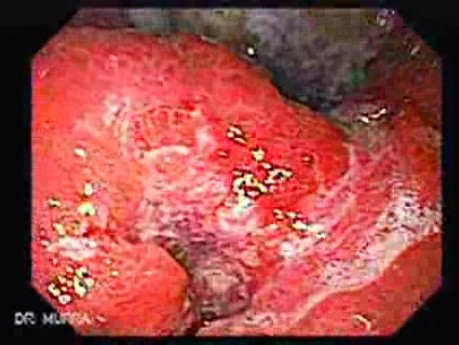 Adenocarcinoma of the Gastric Antrum That Infiltrates The Lesser Curvature (2 of 3)