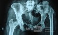 Neglected CDH left HIP