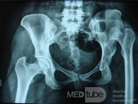Neglected CDH left HIP