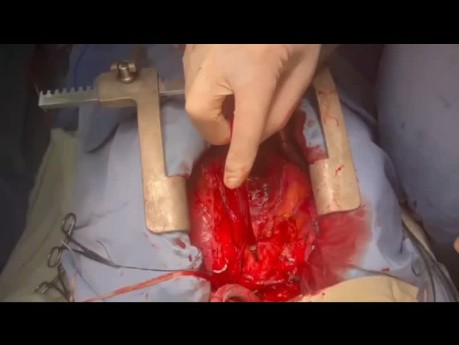 Redo Arch Operation and PVL Control