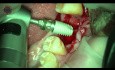 Dental Laser Assisted in Oral Implantology