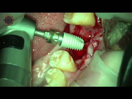 Dental Laser Assisted in Oral Implantology