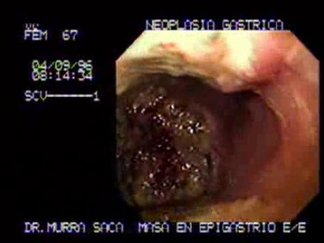 Large Gastric Adenocarcinoma - Endoscopy