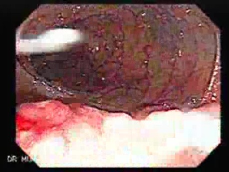 Familial Adenomatous Polyposis (13 of 36)