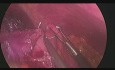 Mini-gastric Bypass after Sleeve Gastrectomy