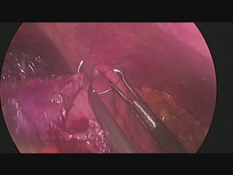 Mini-gastric Bypass after Sleeve Gastrectomy