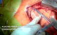 Aortic and Mitral Valve Replacement via Sternotomy