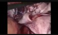 28 Week Size Chocolate Cyst Excision with Preservation of Ovary