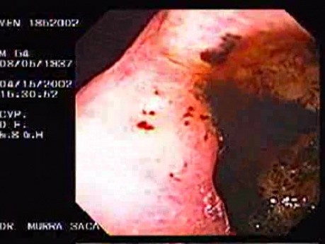 Zollinger- Ellison Syndrome - Gastric Ulcer with Gastrocolic Fistula (3 of 21)