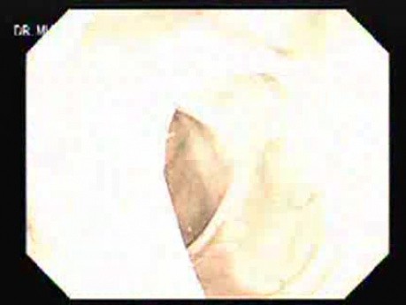 Narrow Band Imaging (NBI) (2 of 3)