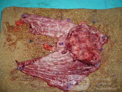 Adenocarcinoma of the cardias and gastric fundus with signet-ring cells (10 of 25)