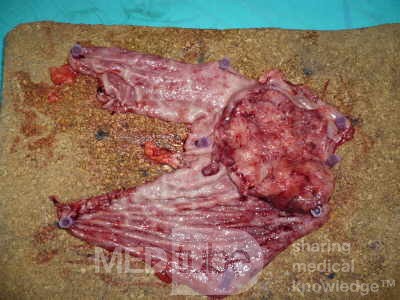 Adenocarcinoma of the cardias and gastric fundus with signet-ring cells (10 of 25)
