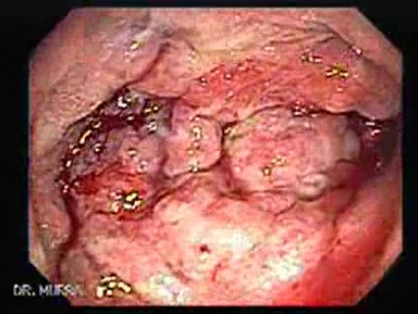 Severe case of Ischemic Colitis (11 of 19)