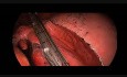 Awake Uniportal VATS Middle Lobectomy for Lung Cancer (under Spontaneous Ventilation)