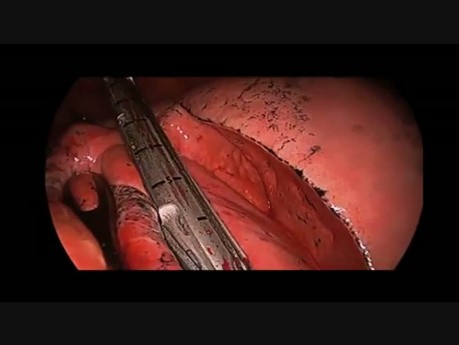 Awake Uniportal VATS Middle Lobectomy for Lung Cancer (under Spontaneous Ventilation)
