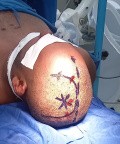 Surgical Planning with Neuronavigator in Patient with Intracranial Mass Lesion. High Grade Glioma.