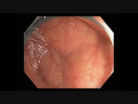 Colonoscopy Channel Quiz 5