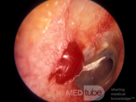 Hematoma External Canal