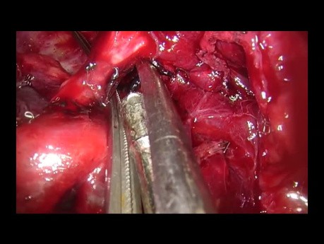 Uniportal VATS En Bloc Anatomic Segmentectomy S10a+S6+S2