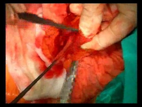 Open Right Hemicolectomy – Technical Principles - Operation No 1B - Part 4