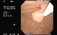 Endoscopic treatment of complications after  GIST removal