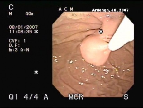 Endoscopic treatment of complications after  GIST removal