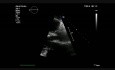 Mitral Valve Flail Anterior Leaflet