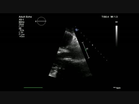 Mitral Valve Flail Anterior Leaflet