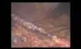 Idiopathic omental infarction