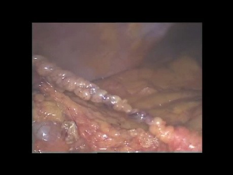 Idiopathic omental infarction