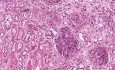 Microscopic polyarteritis - Histopathology - Kidney