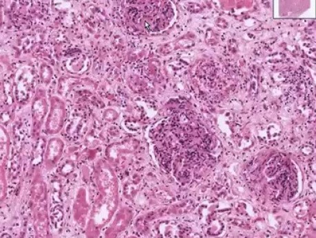 Microscopic polyarteritis - Histopathology - Kidney