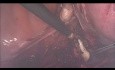 Total Laparoscopic Hysterectomy - How To Do It? Step By Step