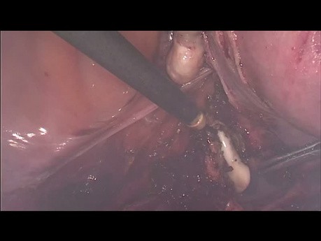 Total Laparoscopic Hysterectomy - How To Do It? Step By Step